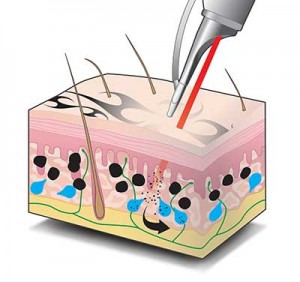 tattooentfernung laser